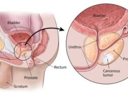 Εκατοντάδες νέες διαγνώσεις ετησίως στην Κύπρο για καρκίνο του προστάτη