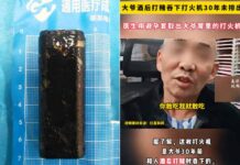 Γιατροί αφαίρεσαν έναν αναπτήρα από το στομάχι άνδρα που το είχε καταπιεί πριν από… 30 χρόνια